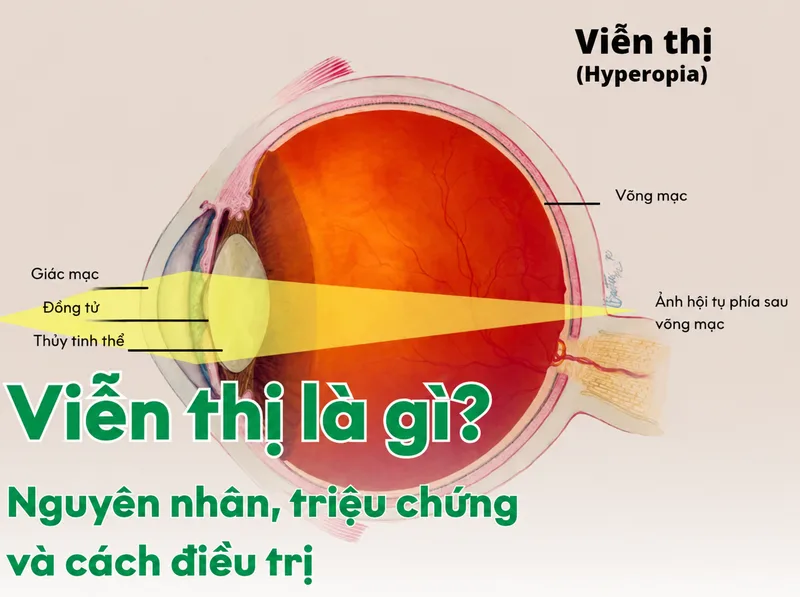 Viễn thị là tật khúc xạ khiến người mắc thường nhìn gần kém rõ và dễ mỏi mắt khi đọc sách, làm việc.