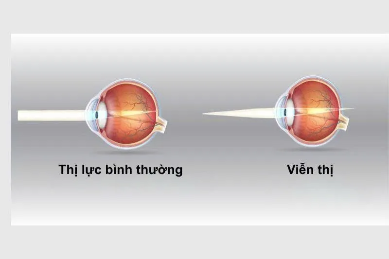 Viễn thị có thể liên quan đến trục nhãn cầu ngắn, giác mạc dẹt hoặc yếu tố di truyền trong gia đình.