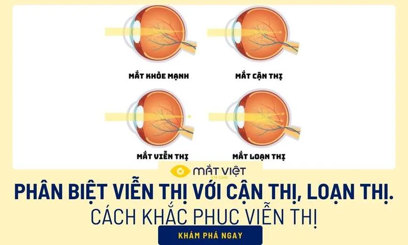 Viễn thị, cận thị, loạn thị và lão thị đều ảnh hưởng thị lực nhưng khác nhau về nguyên nhân và biểu hiện.